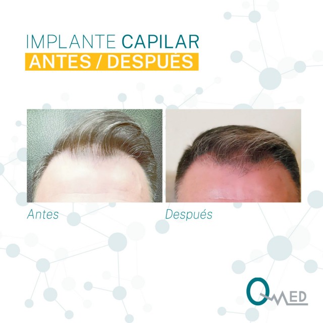 Resultados de un injerto capilar tras 4 meses | QMED, especialistas en implantes capilares en España