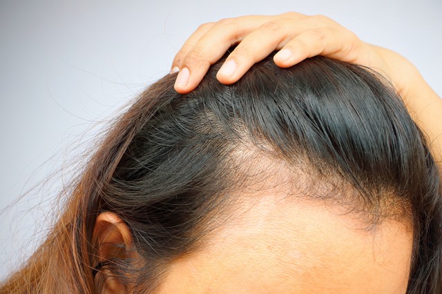 Cómo es alopecia mujeres? - Blog