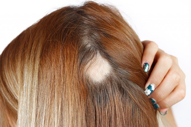 La alopecia areata se desarrolla más en mujeres jóvenes