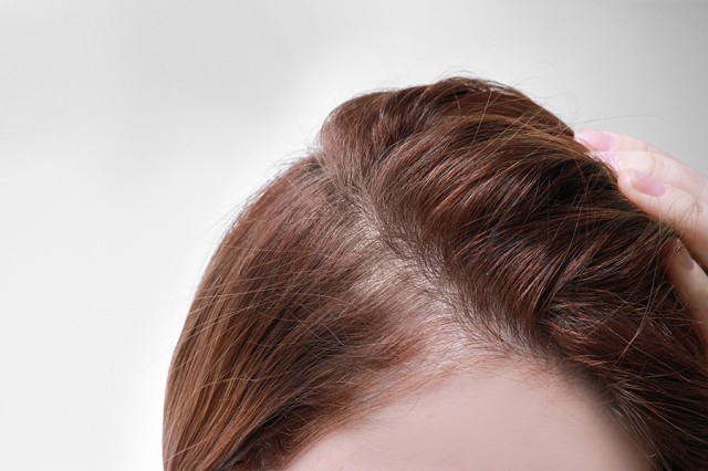 Comienzo de alopecia difusa en mujer