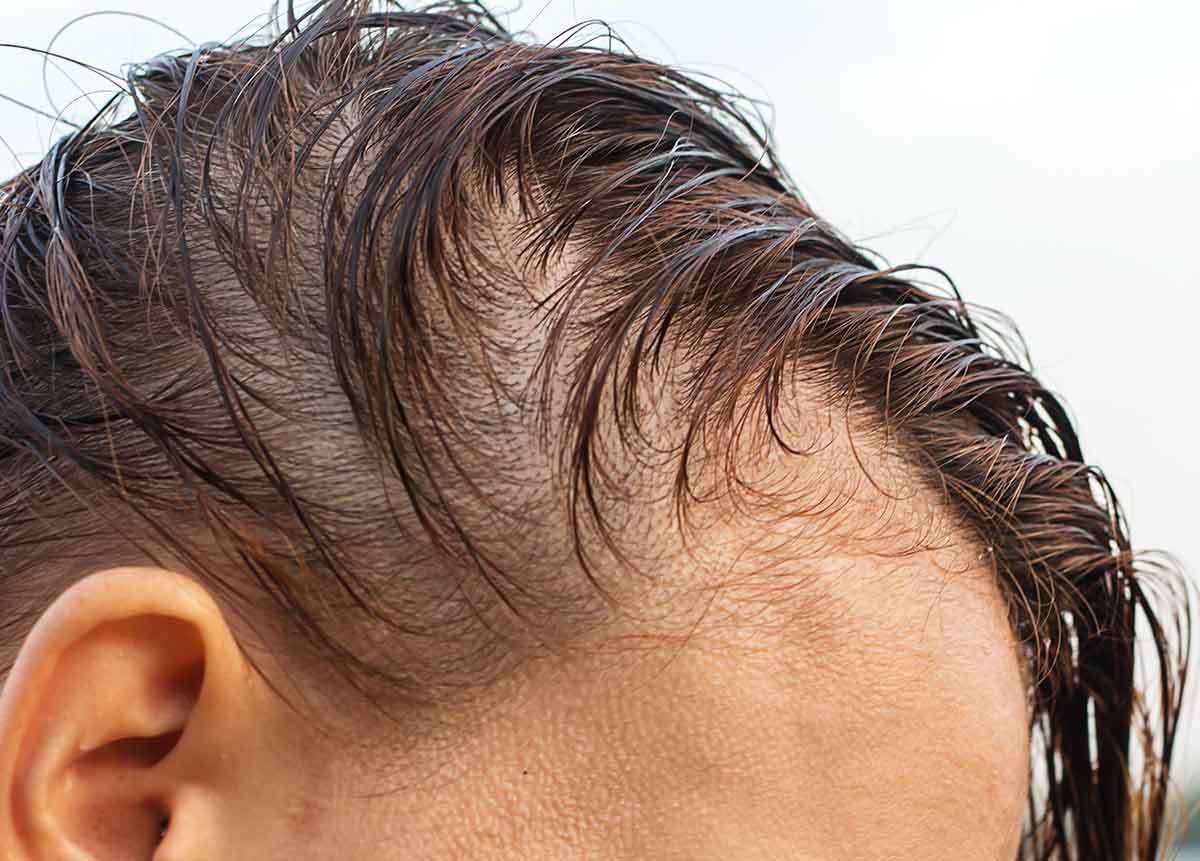 que te diviertas ballena grande Alopecia difusa: qué es y cómo tratarla - Blog