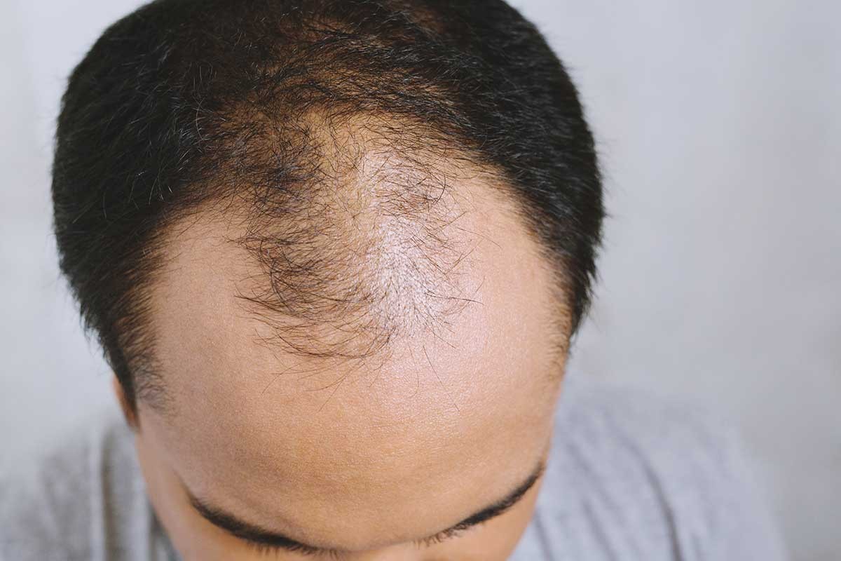Alopecia androgenética y su tratamiento